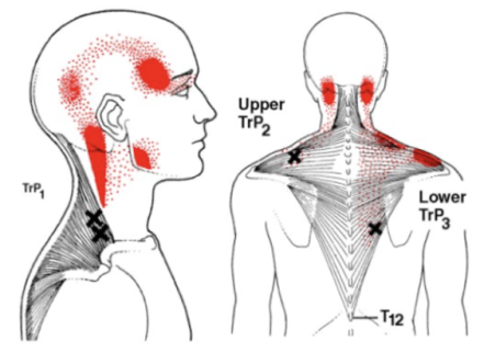 Anatomische illustratie van triggerpoints in de nek en rug met uitstralingsgebieden