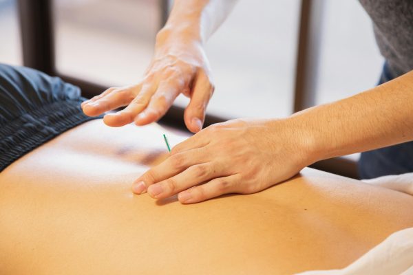 Dry needling behandeling op de rug met een enkele naald.