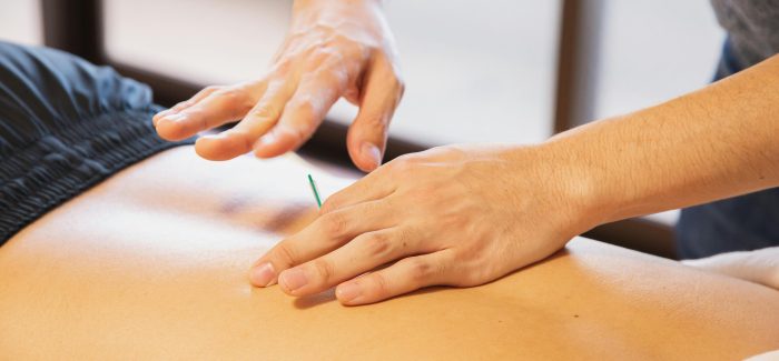 Dry needling behandeling op de rug met een enkele naald.